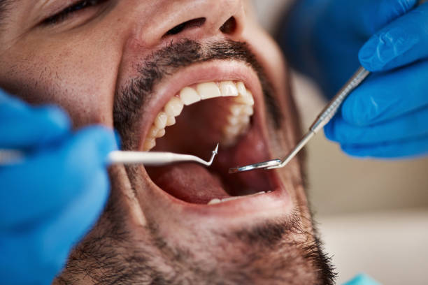 Best Emergency Root Canal Treatment in Four Oaks, NC