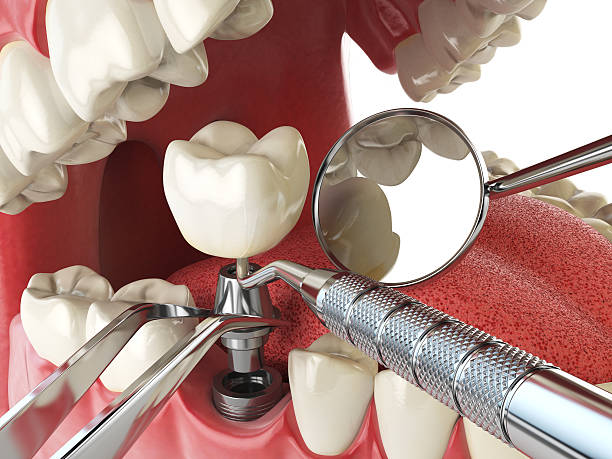 Best Emergency Dental Extractions in Four Oaks, NC